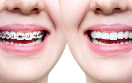 invisalign dentist in Agoura Hills